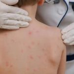 México pierde eliminación del sarampión por12 meses de contagio