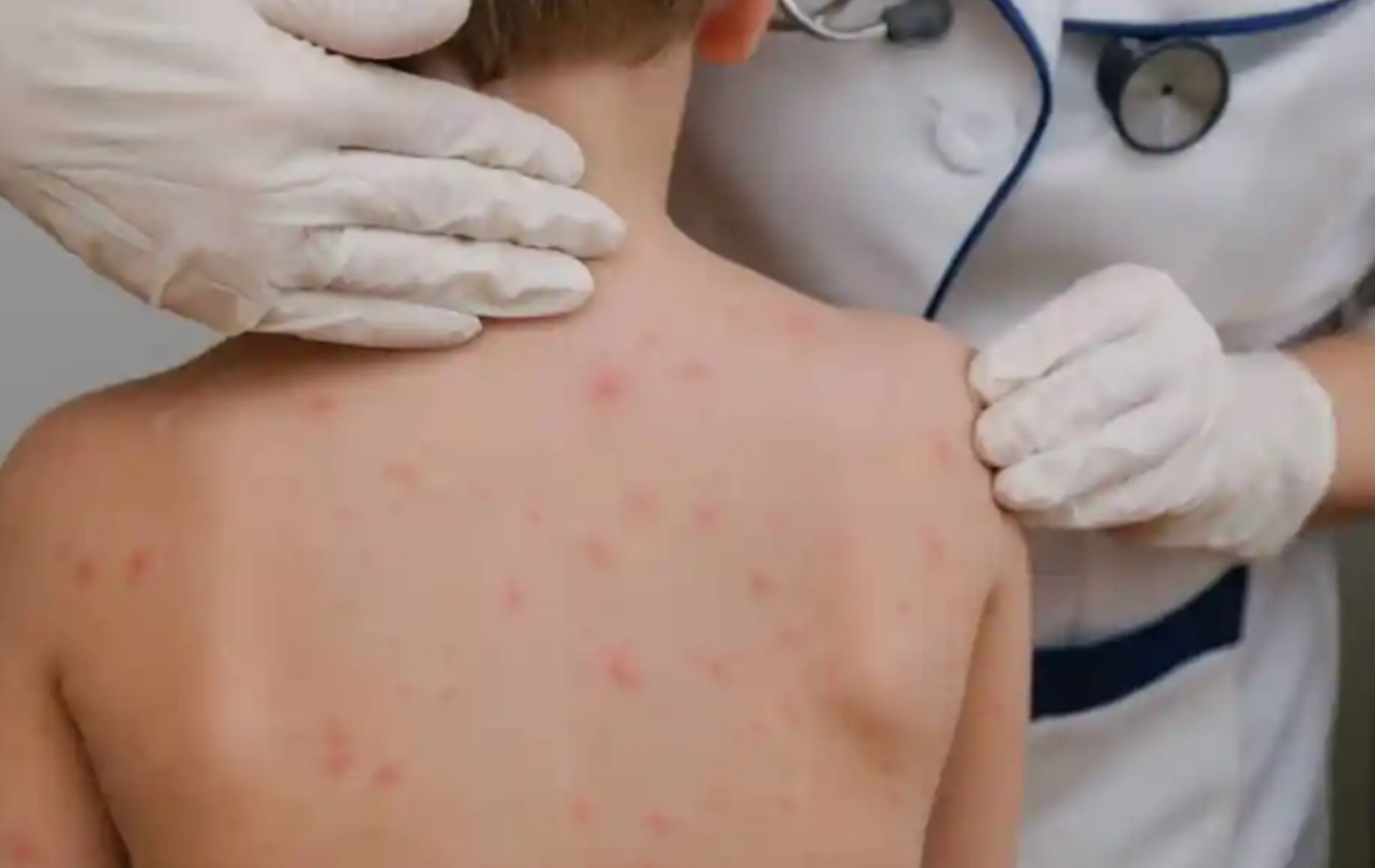 México pierde eliminación del sarampión por12 meses de contagio