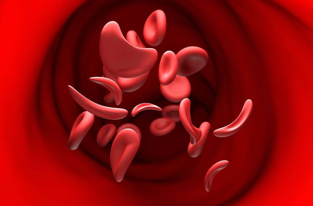 Anemia falciforme en Colombia: hay avances científicos en 2026 / Getty Images
