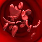 Anemia falciforme en Colombia: hay avances científicos en 2026 / Getty Images