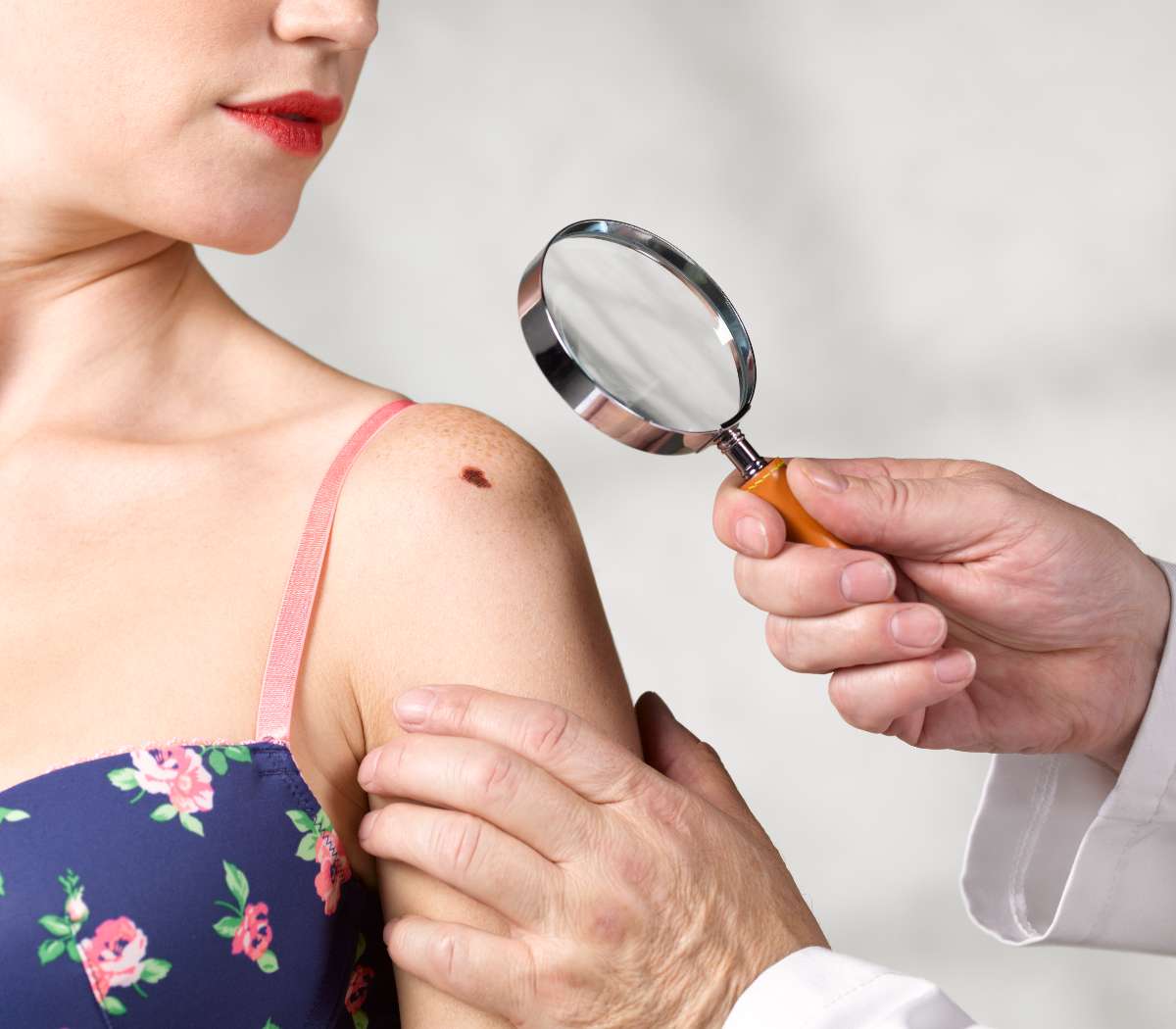 Melanoma en Colombia: casos previstos en jornadas gratuitas / Getty Images