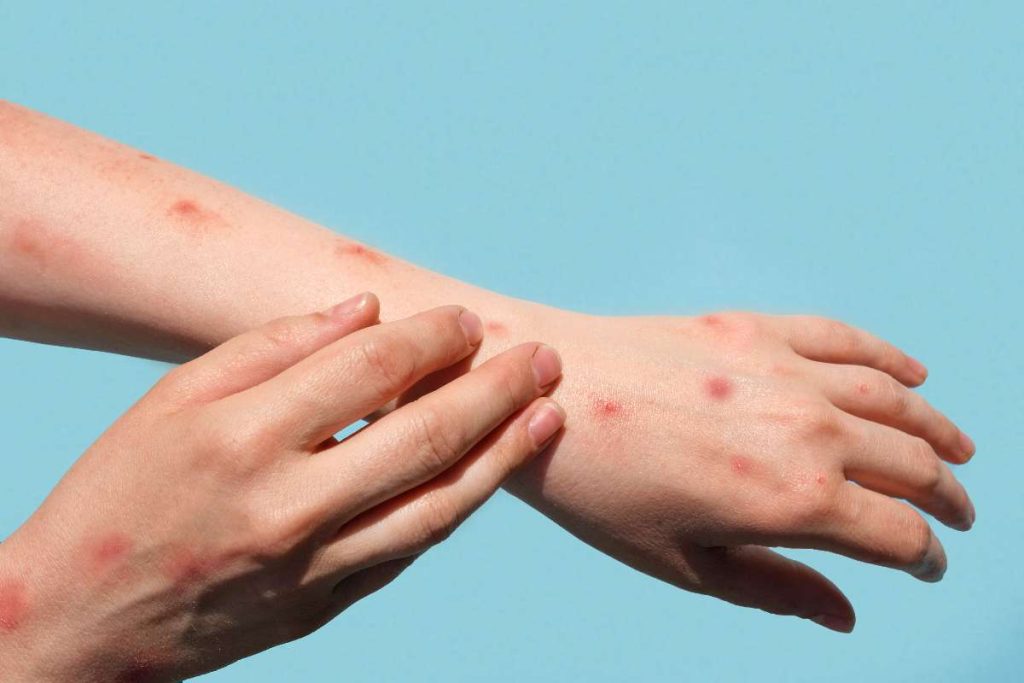 Mpox clado Ib alerta a Colombia_ detalles de nueva infección viral / Getty Images